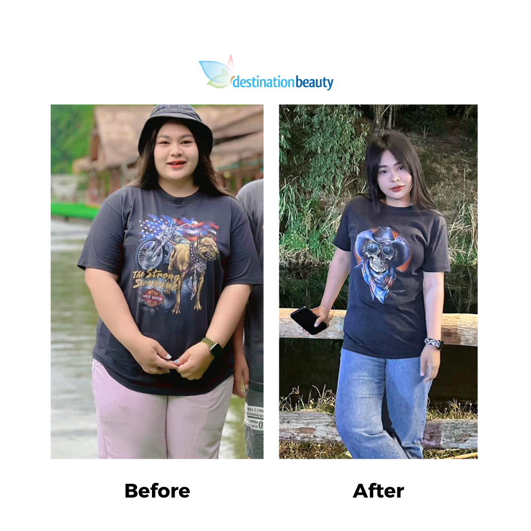 Ananya before and after gastric sleeve (2)