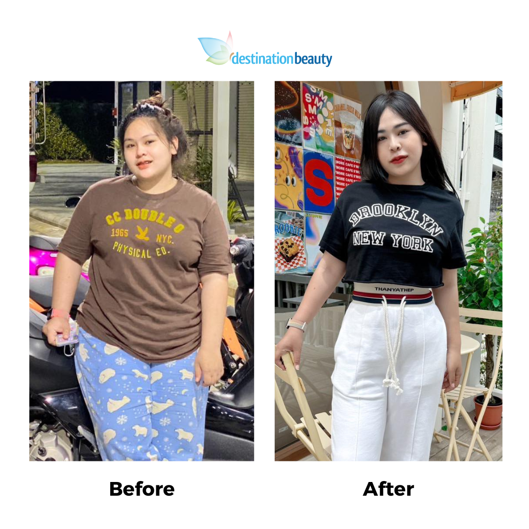 Ananya before and after gastric sleeve