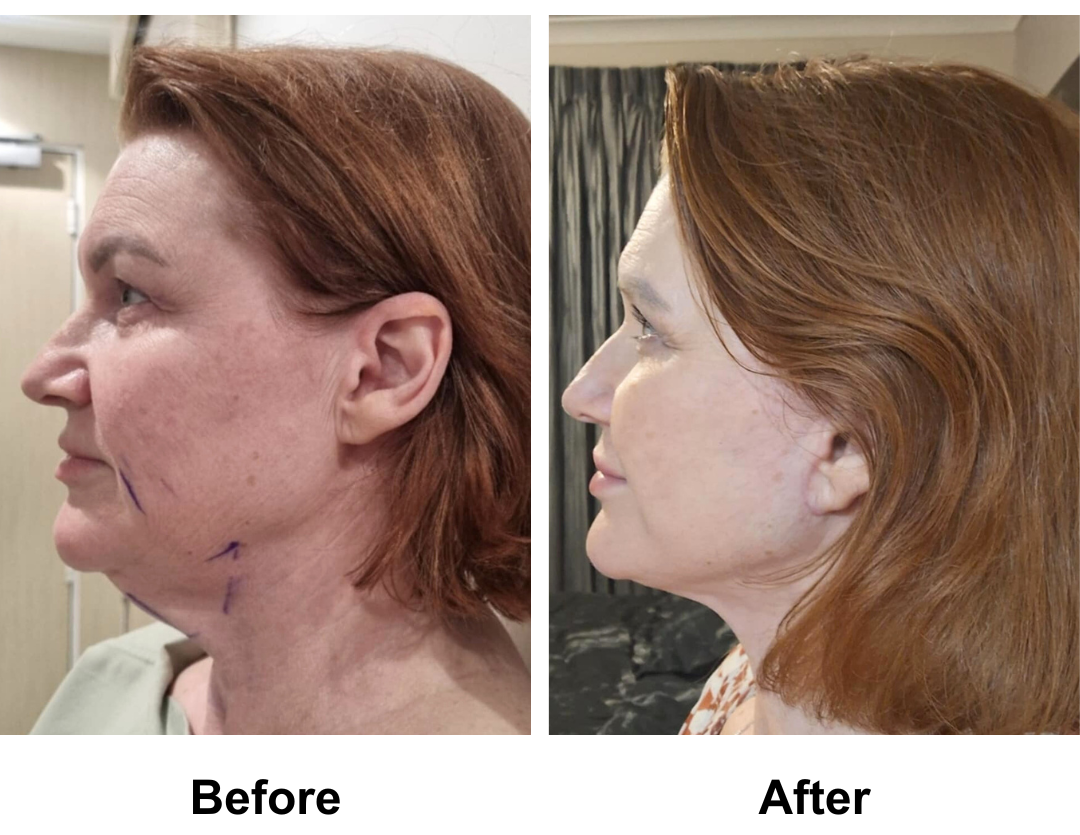 Angela Angela had MFNL + Sub Brow Lift + Liposuction at under chin with Dr. NJ