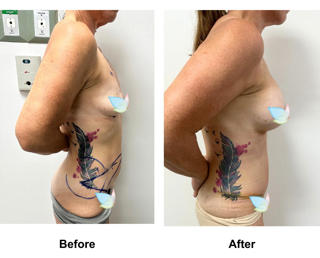 Angela had BA (Rt 300HP, Lt 250 Mplus)+ ExTT with Dr. Kasemsak (2)