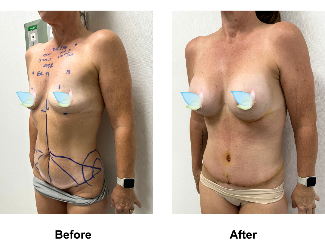 Angela had BA (Rt 300HP, Lt 250 Mplus)+ ExTT with Dr. Kasemsak (3)