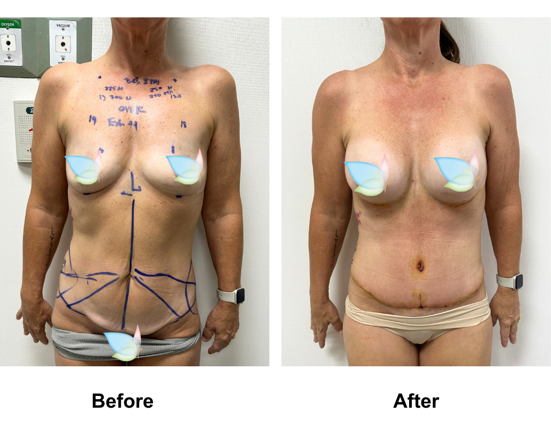 Angela had BA (Rt 300HP, Lt 250 Mplus)+ ExTT with Dr. Kasemsak