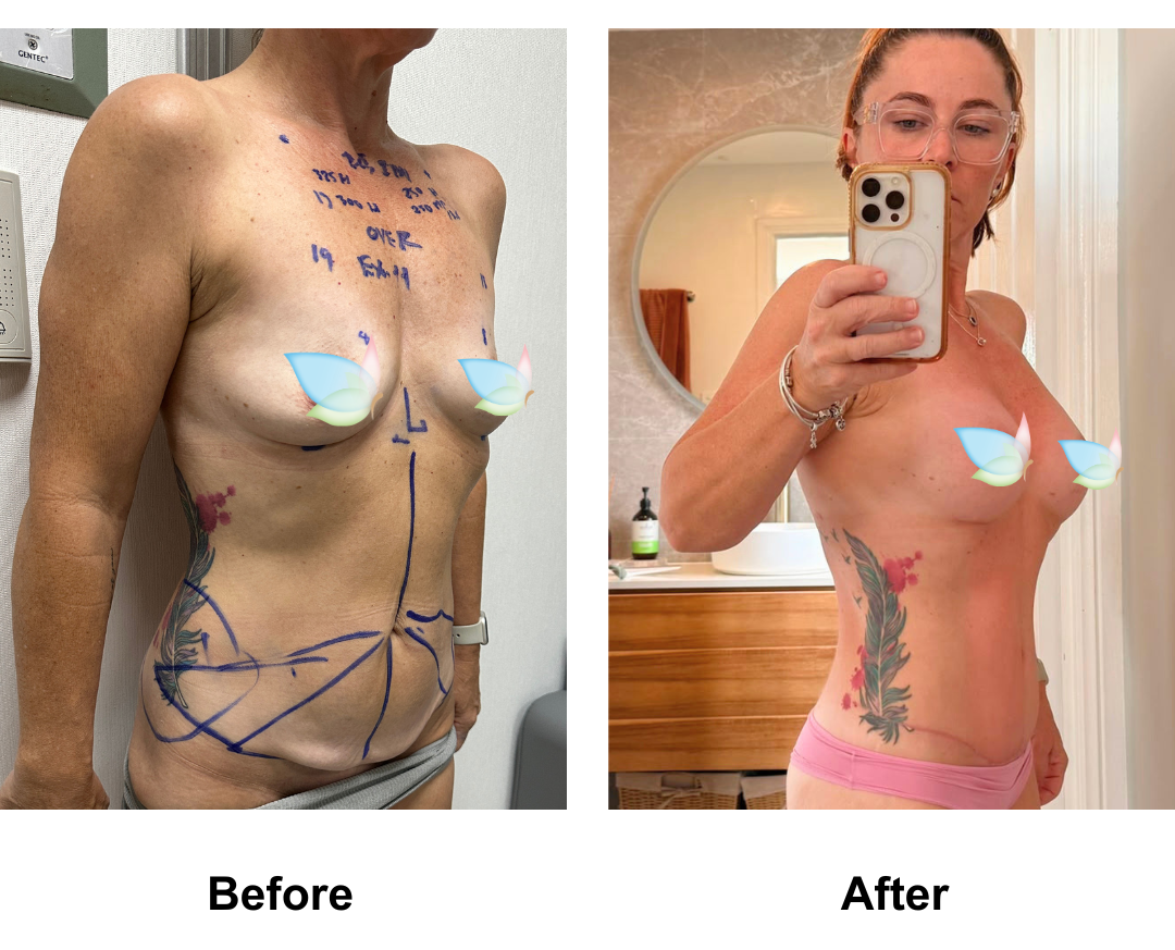 Angela had BA + ExTT + Lipo_1 with Dr. Kasemsak (3)
