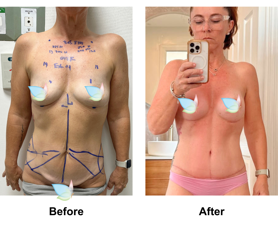 Angela had BA + ExTT + Lipo_1 with Dr. Kasemsak