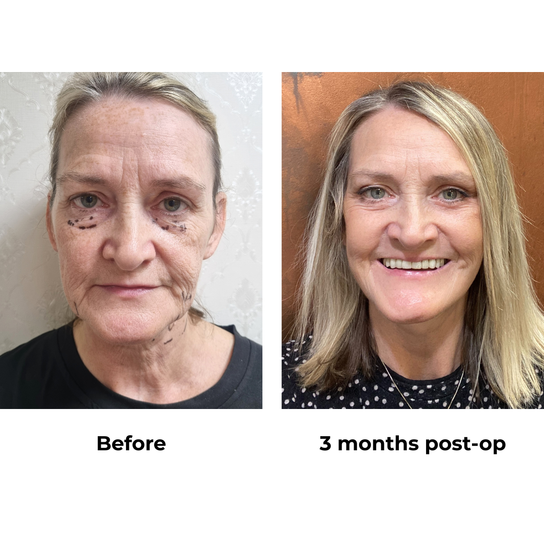 Angela had FFNL + LB with Dr. Ring