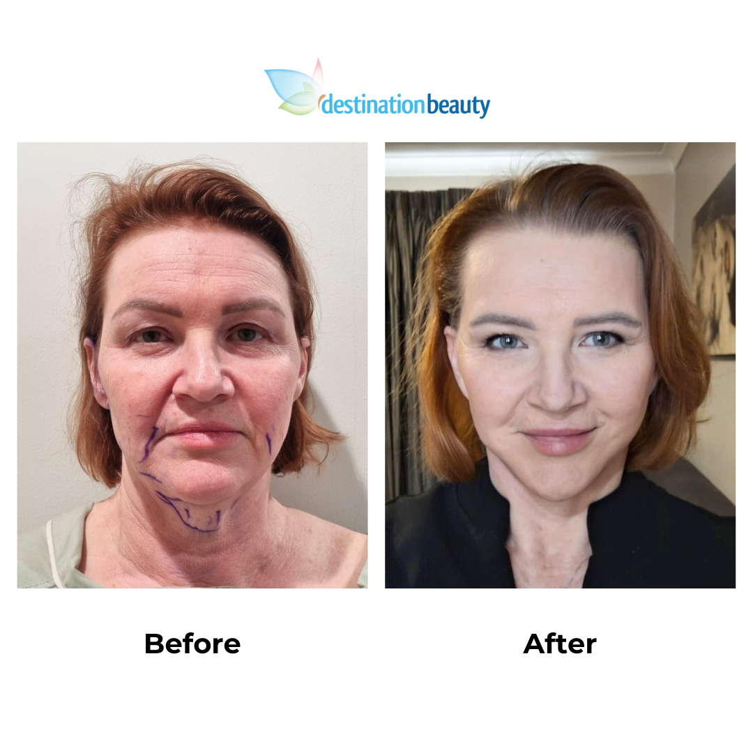 Angela had facelift with Dr. NJ 6 weeks post op