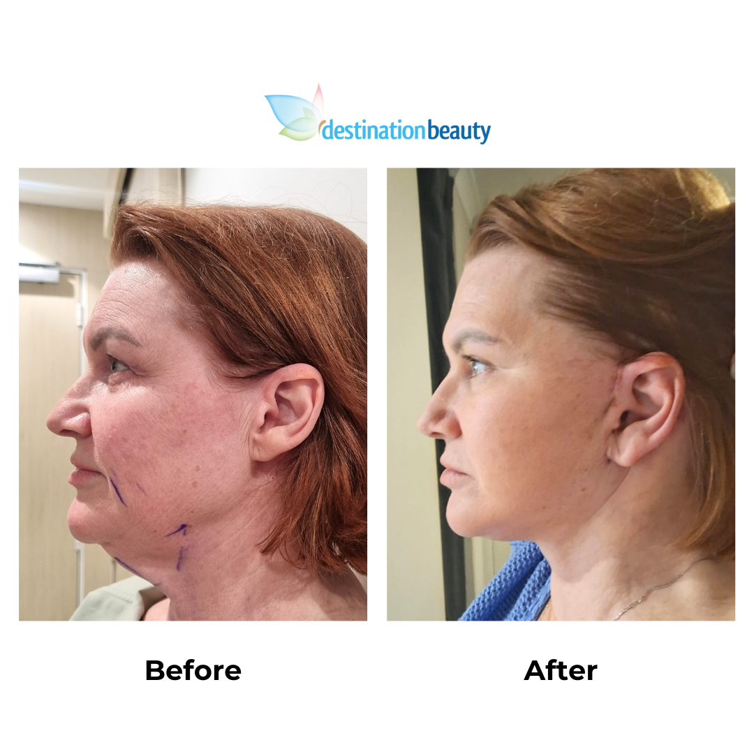 Angela had facelift with Dr. NJ-1