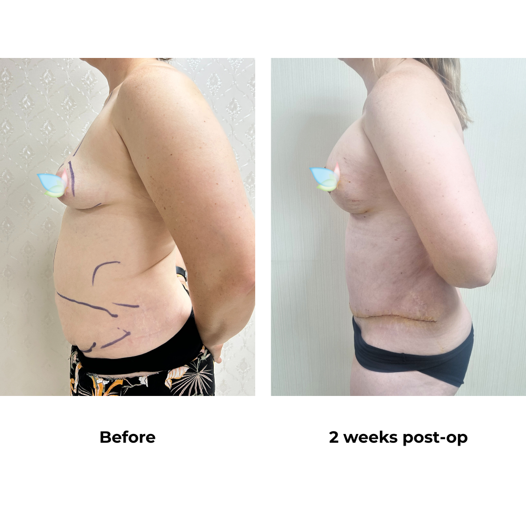 Angelena had BABL + ExTT + Lipo with Dr. Ring (2)
