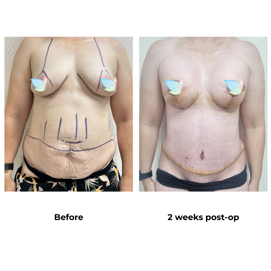 Angelena had BABL + ExTT + Lipo with Dr. Ring