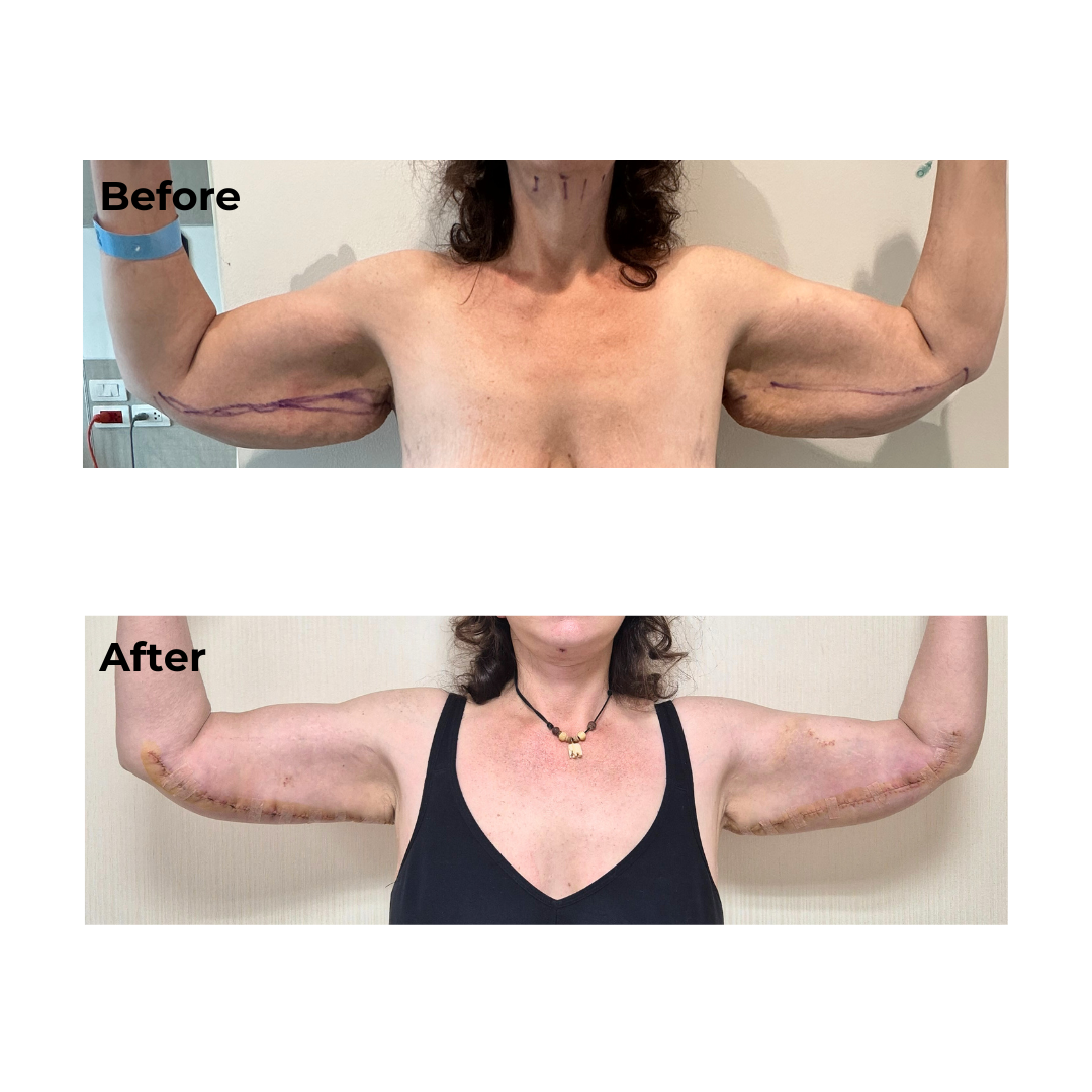 Anita had arm lift in Thailand with Dr. NJ