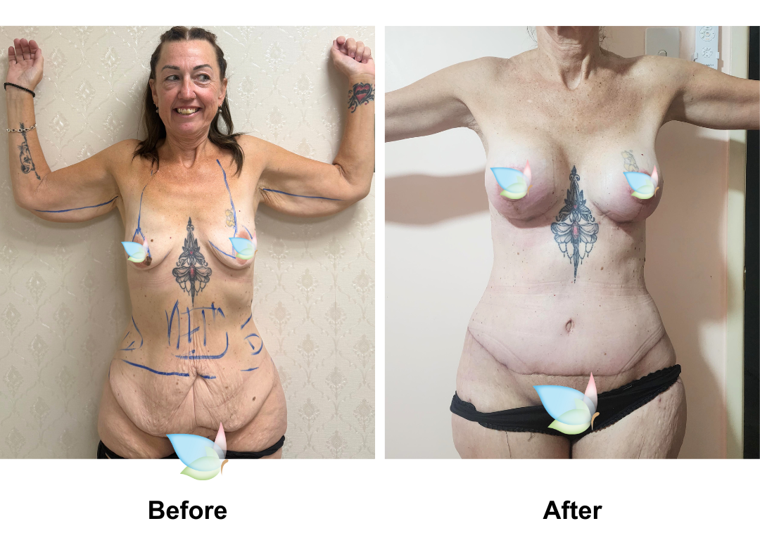 Annette had ExTT + Lipo2 + ML + BABL (Motiva 315 Full) + AL with Dr. Ring  (2)