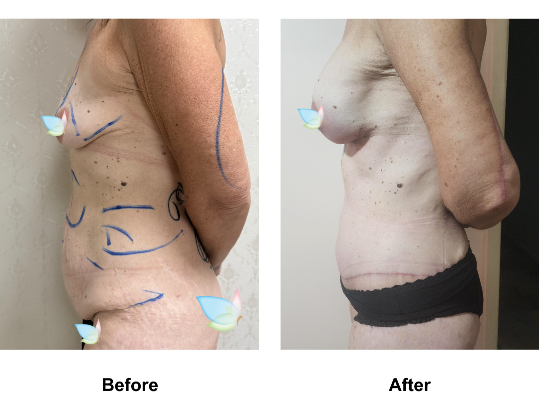 Annette had ExTT + Lipo2 + ML + BABL (Motiva 315 Full) + AL with Dr. Ring