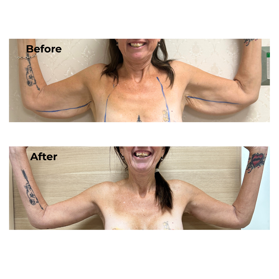 Annettes ExTT + Lipo + ML + BABL + AL with Dr. Ring - 2 weeks PO (2)
