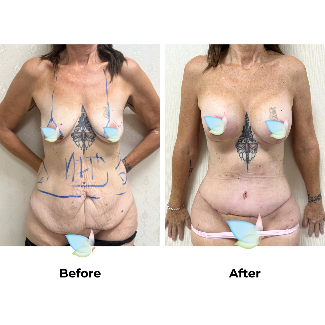 Annettes ExTT + Lipo + ML + BABL + AL with Dr. Ring - 2 weeks PO (3)