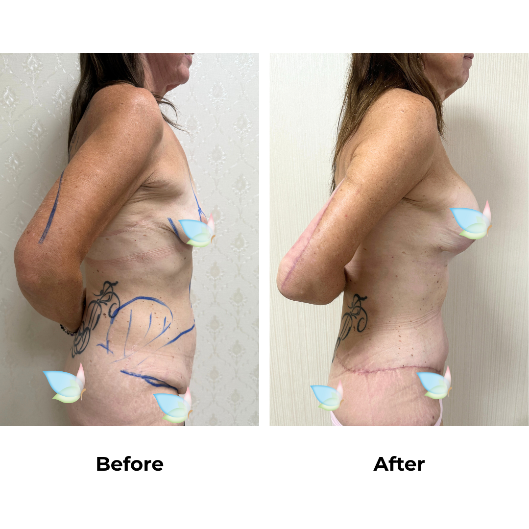 Annettes ExTT + Lipo + ML + BABL + AL with Dr. Ring - 2 weeks PO (4)