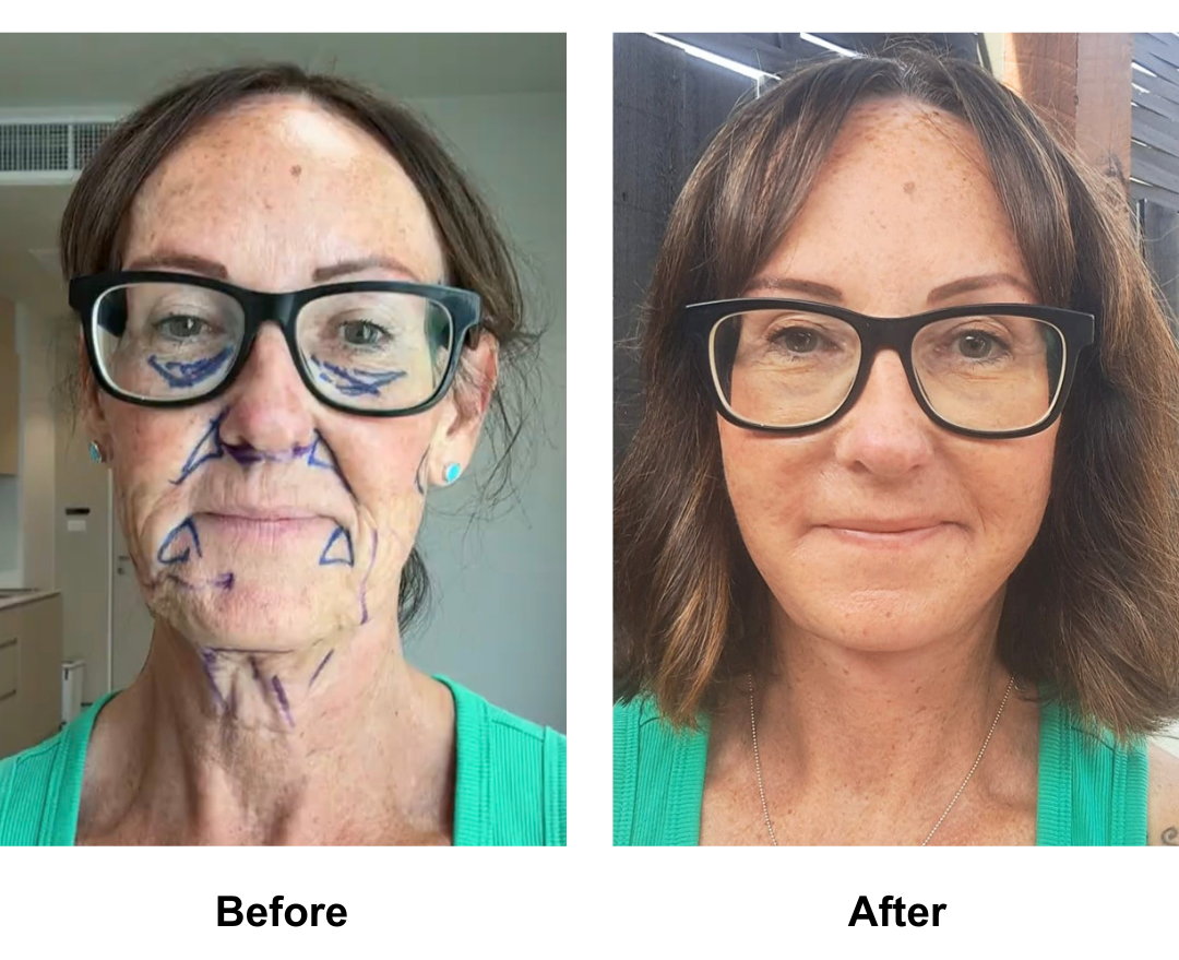 Arlene had FFNL + plastymaplasty + fat transfer to face  with Dr. NJ (2)