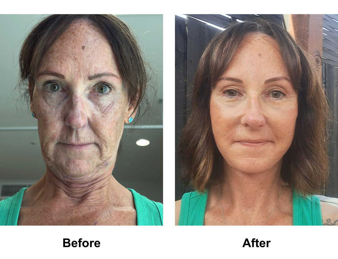 Arlene had FFNL + plastymaplasty + fat transfer to face  with Dr. NJ