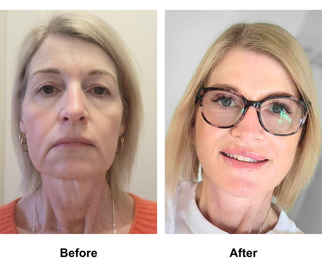 Arlenes 8 months post-facelift with Dr. NJ (1)