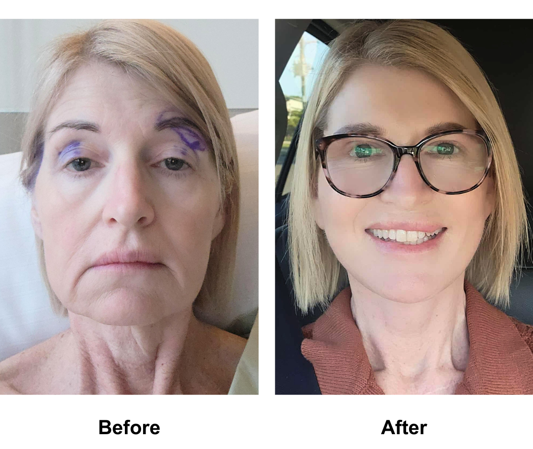 Arlenes 8 months post-facelift with Dr. NJ