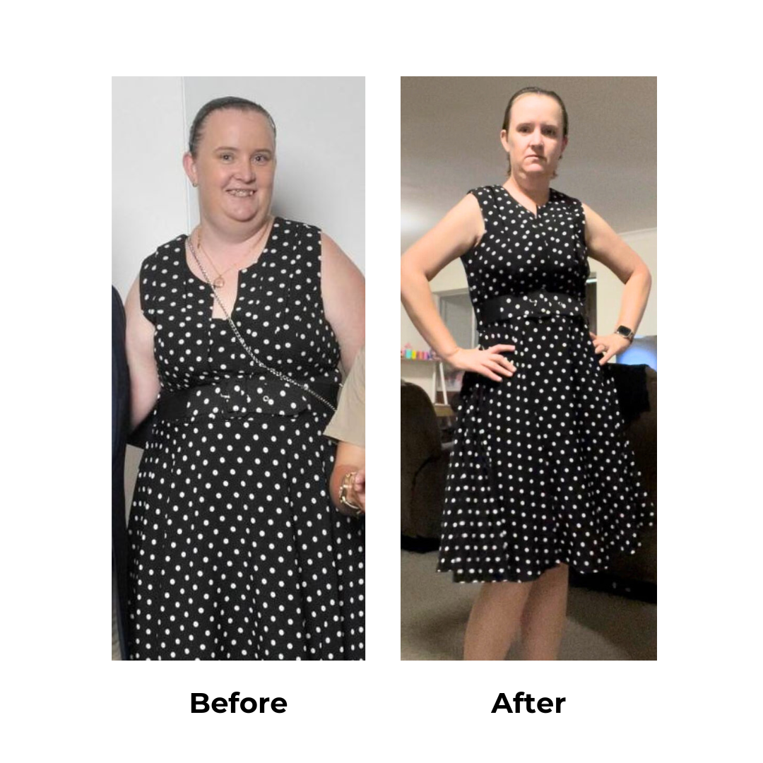 Ashleigh had gastric sleeve surgery (3)