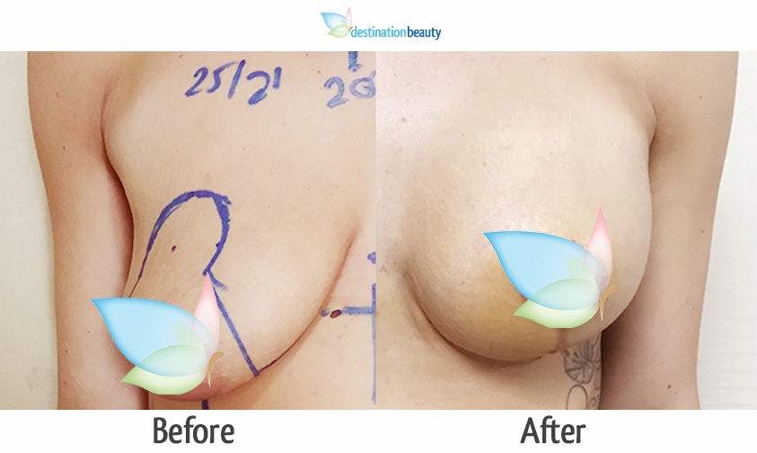 breast reduction with implants thailand