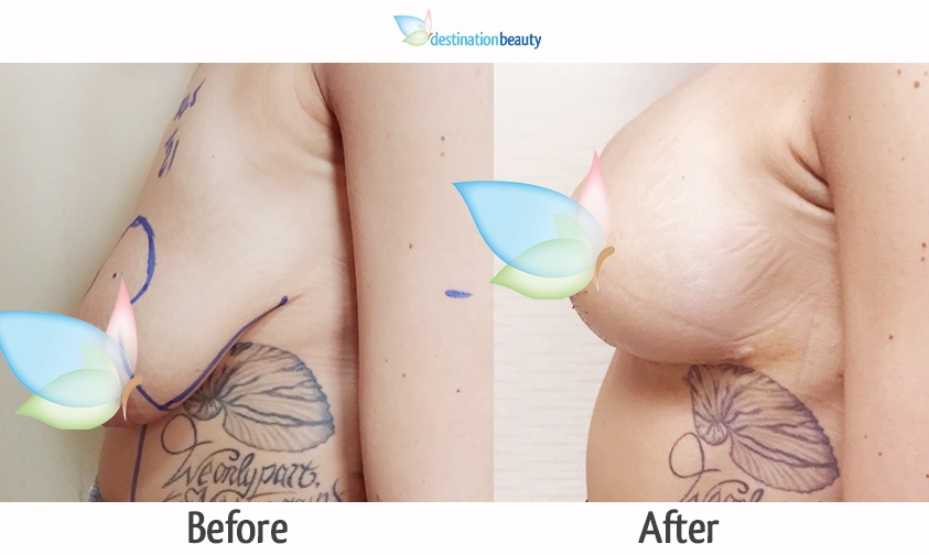 breast reduction with implants thailand before and after