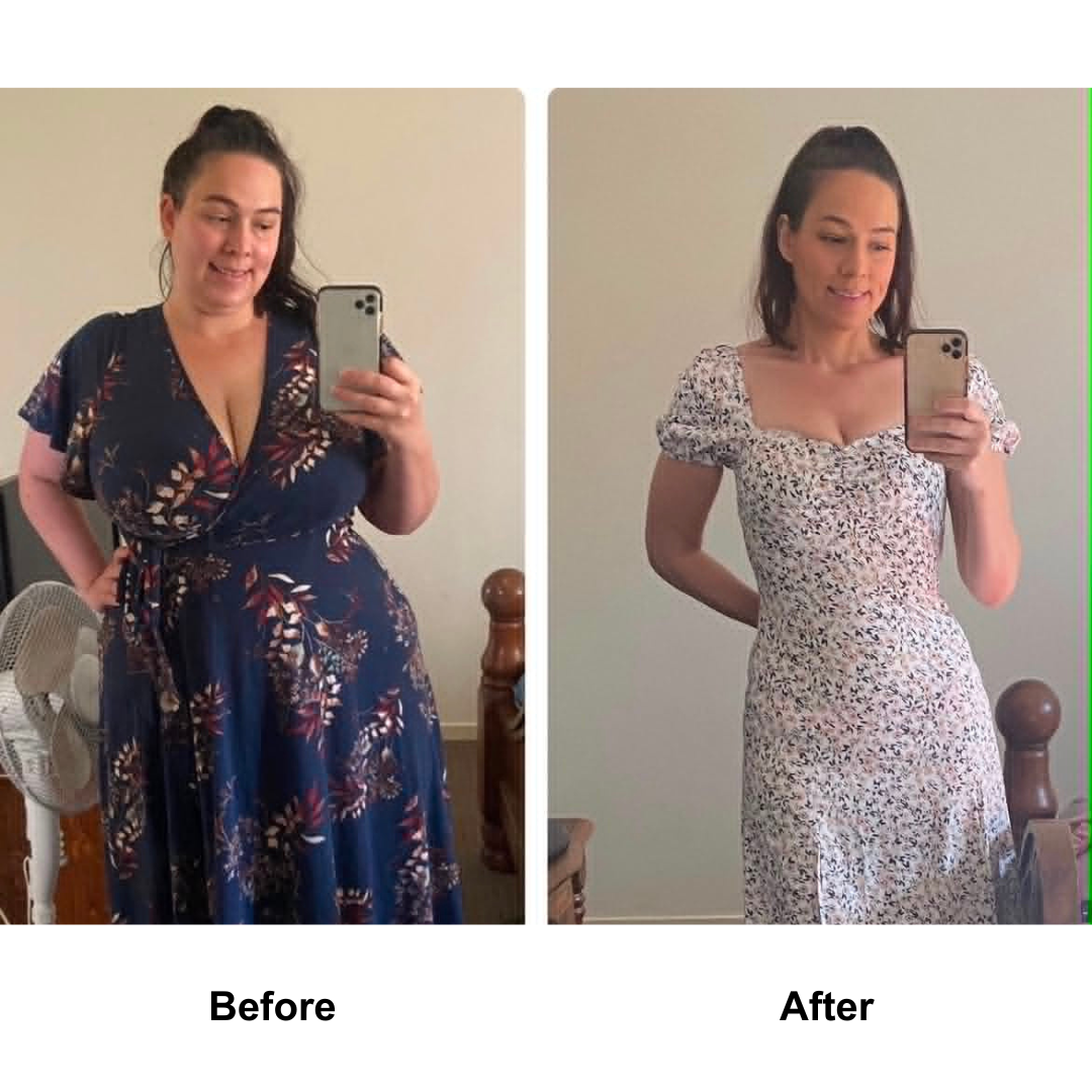 Ashley T had gastric slevee (1)