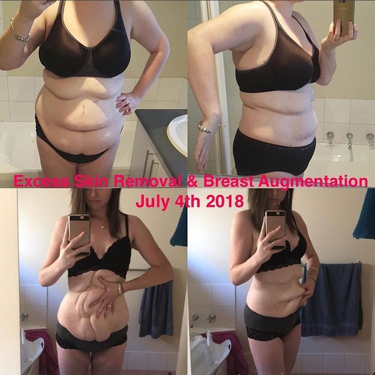 Ashley before and after gastric sleeve