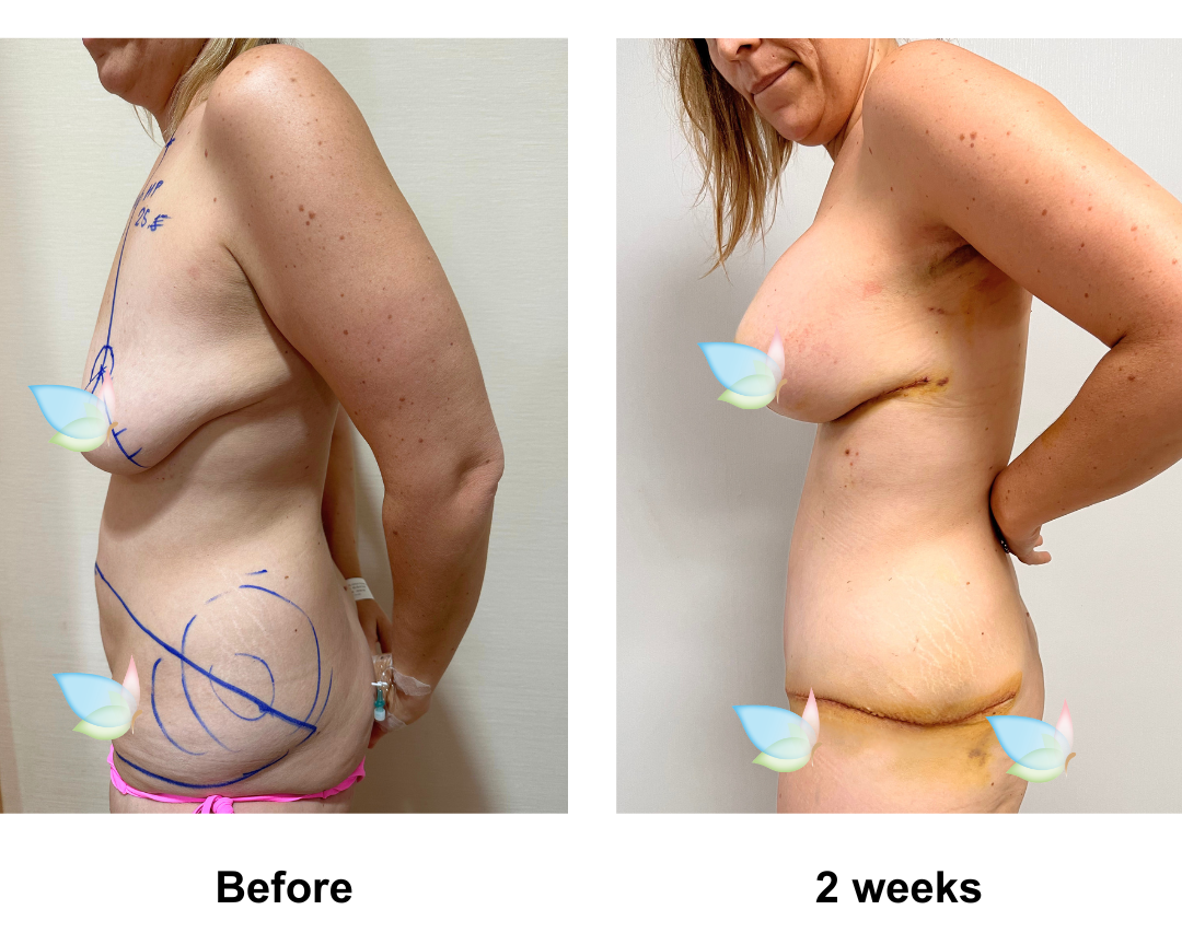 Ashley had BABL (400 HP) + AL + ExTT + ML + Lipo1 with Dr. Angkana  (1)