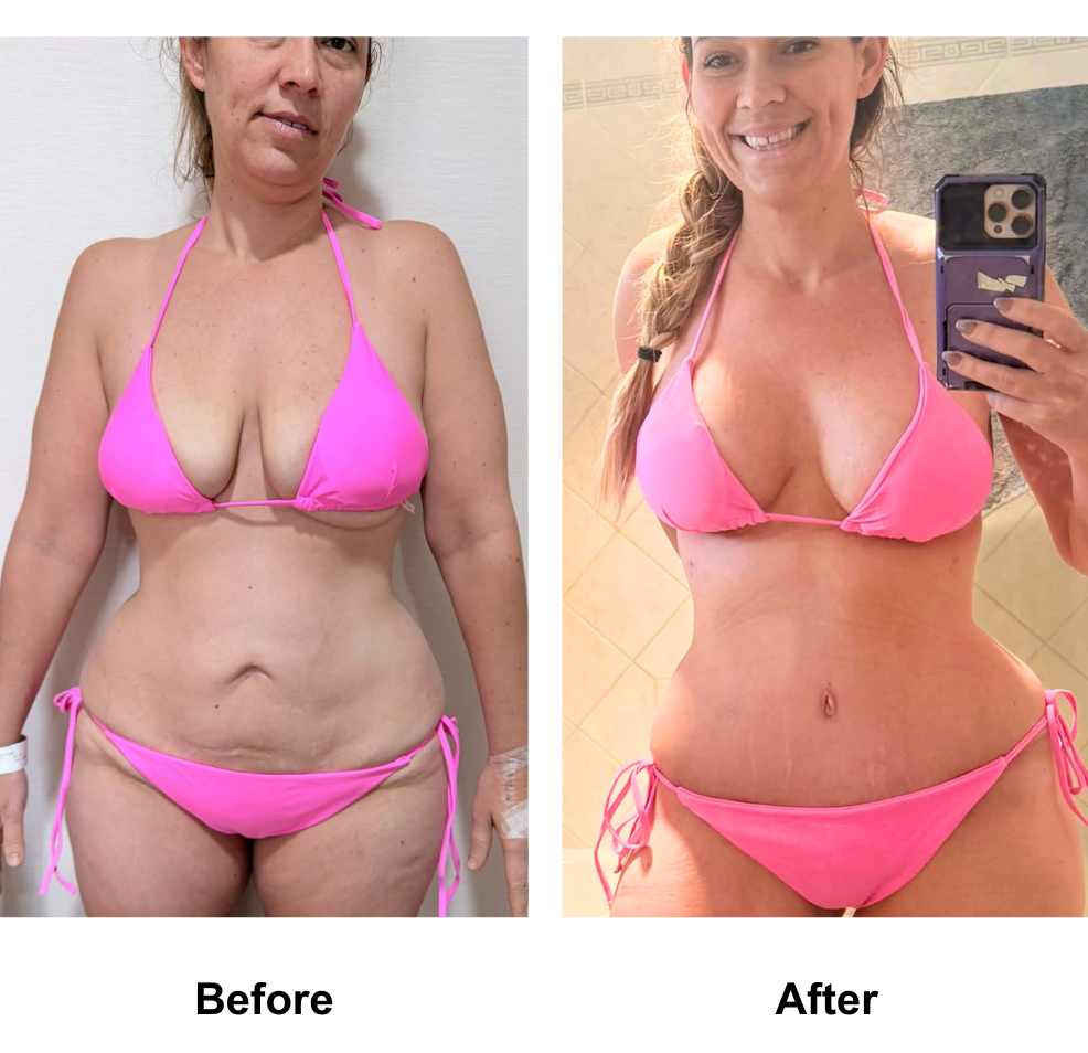 Ashley had BABL (400 HP) + AL + ExTT + ML + Lipo1 with Dr. Angkana  (2)