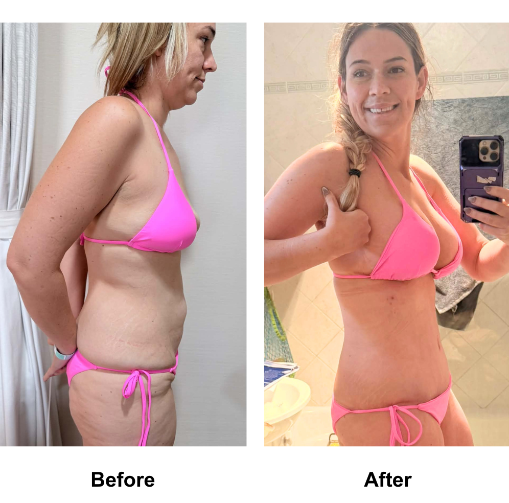 Ashley had BABL (400 HP) + AL + ExTT + ML + Lipo1 with Dr. Angkana  (3)