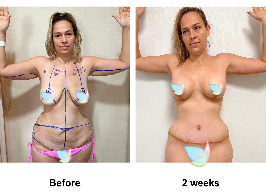 Ashley had BABL (400 HP) + AL + ExTT + ML + Lipo1 with Dr. Angkana