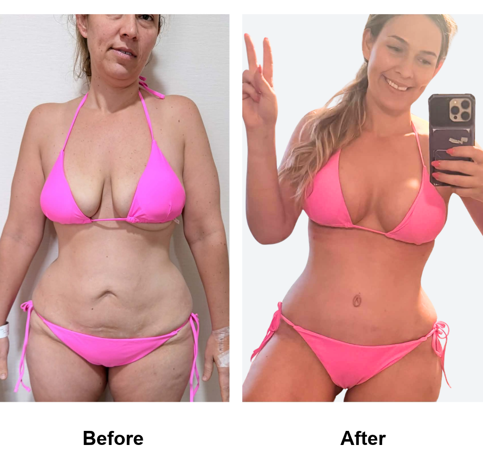 Ashley had BABL (400 HP) + AL + ExTT + ML + Lipo_1 with Dr. Angkana - 7 weeks