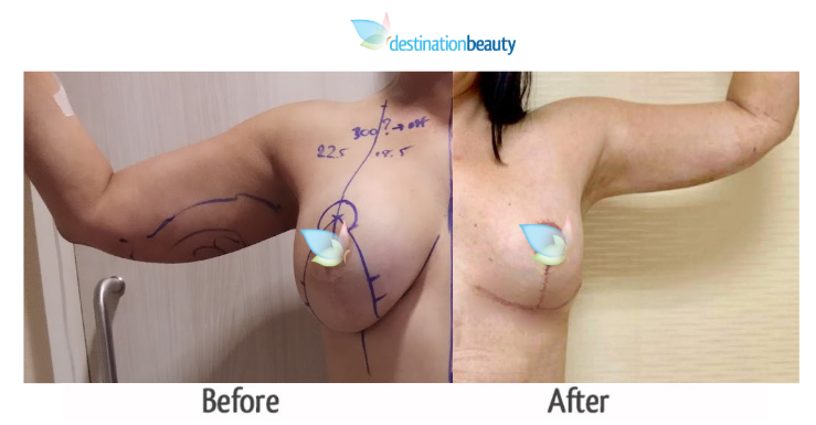 BL_arm liposuction_dr_angkana