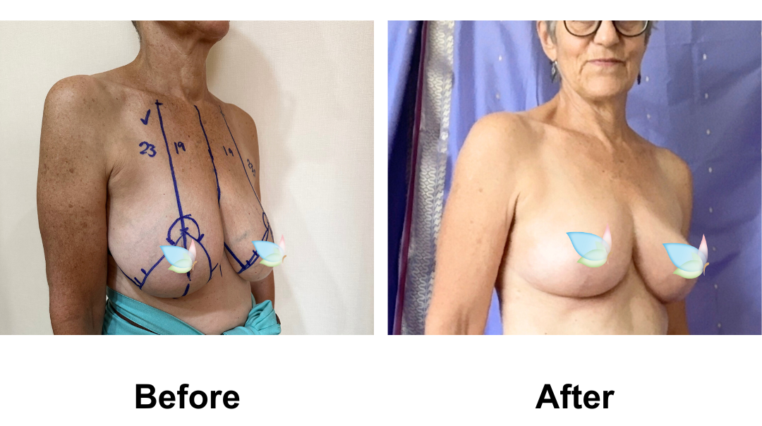 Barbara had BR with Dr. Angkana (1)