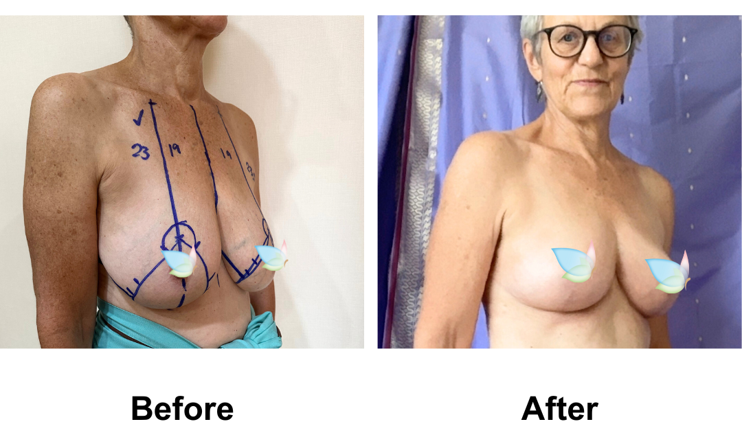 Barbara had BR with Dr. Angkana (2)