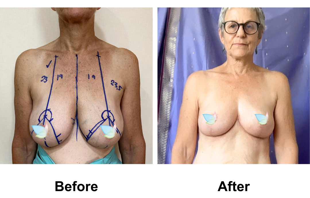 Barbara had BR with Dr. Angkana