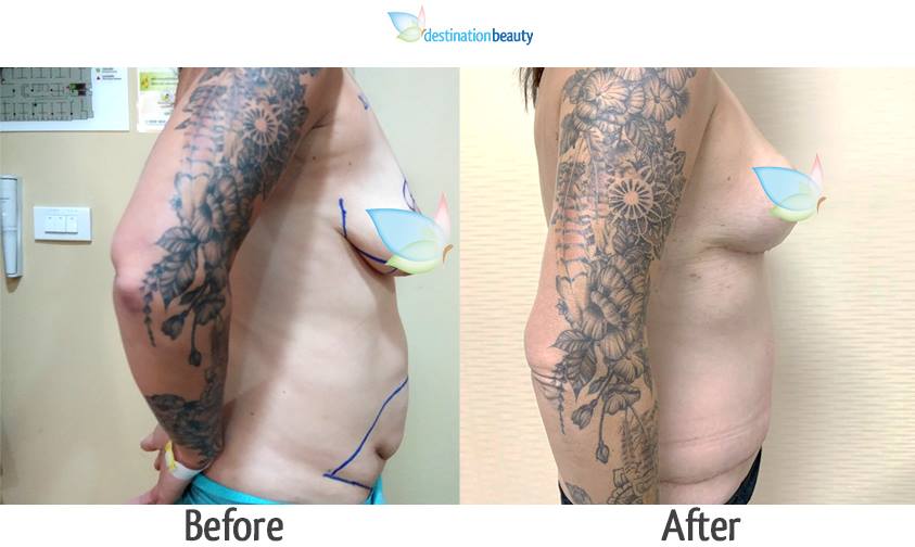 Before and after pictures of breast reduction arm lift and extended tummy tuck