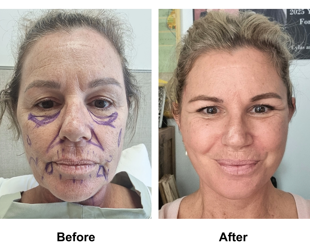 Belinda 53 had FFNL + Fat transfer to Face with Dr. NJ (3)
