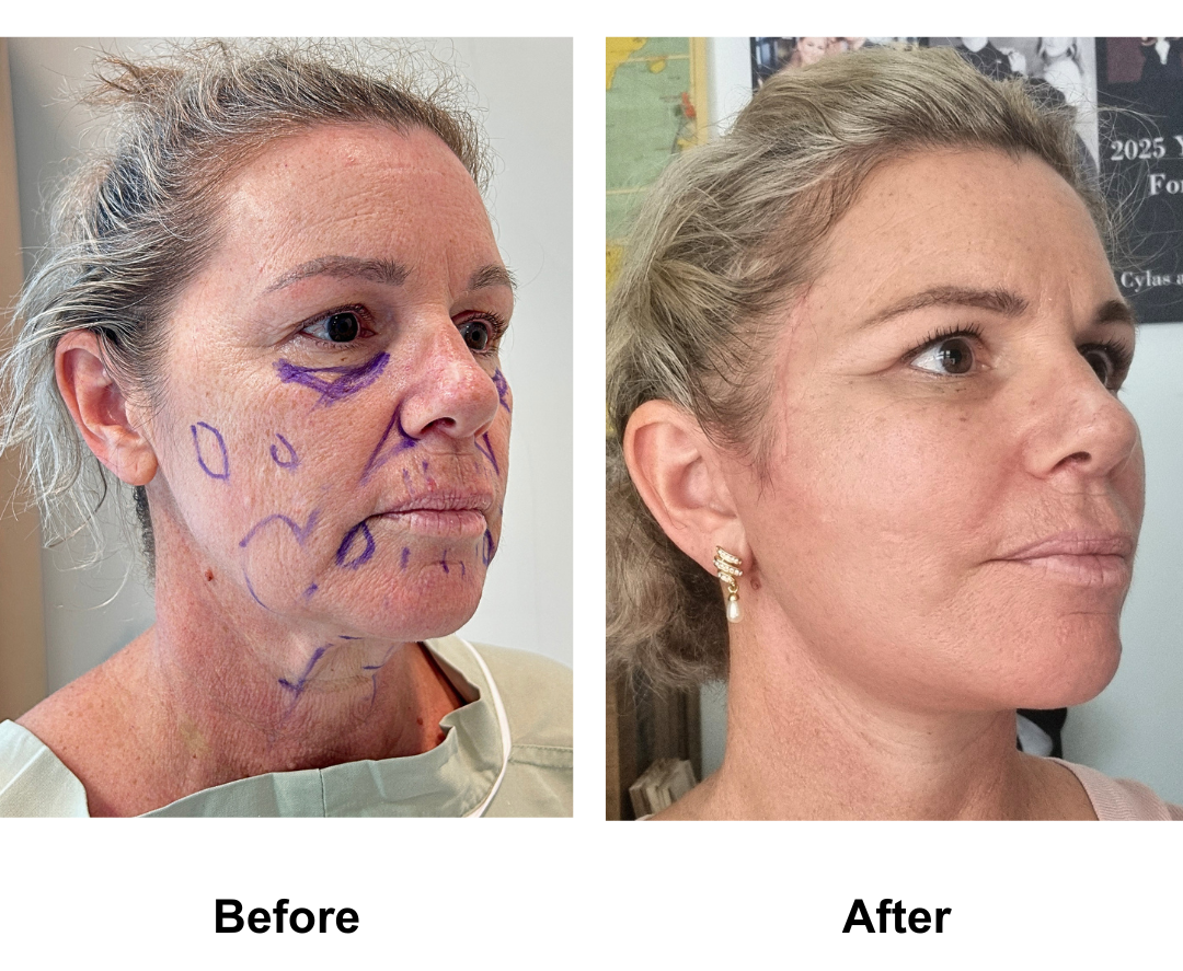 Belinda 53 had FFNL + Fat transfer to Face with Dr. NJ (4)