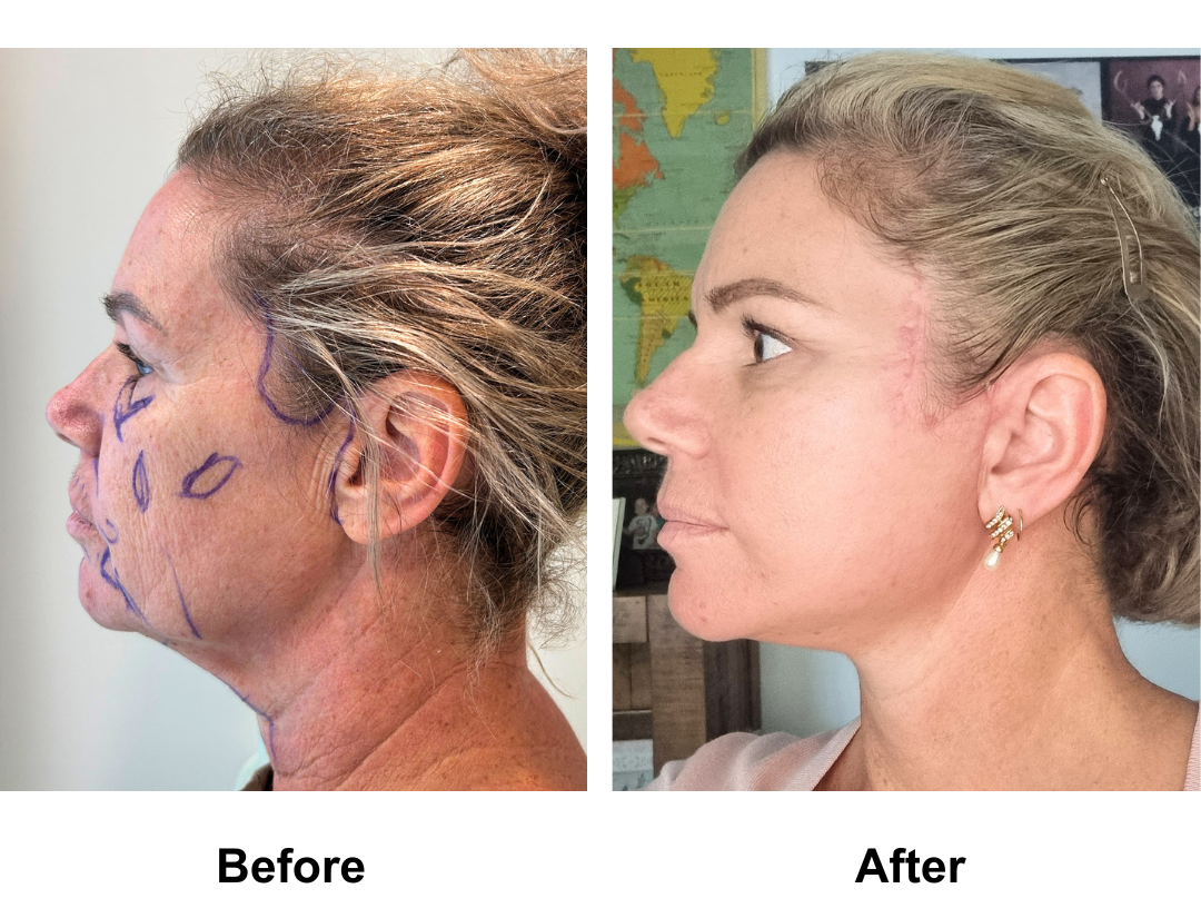 Belinda 53 had FFNL + Fat transfer to Face with Dr. NJ (5)