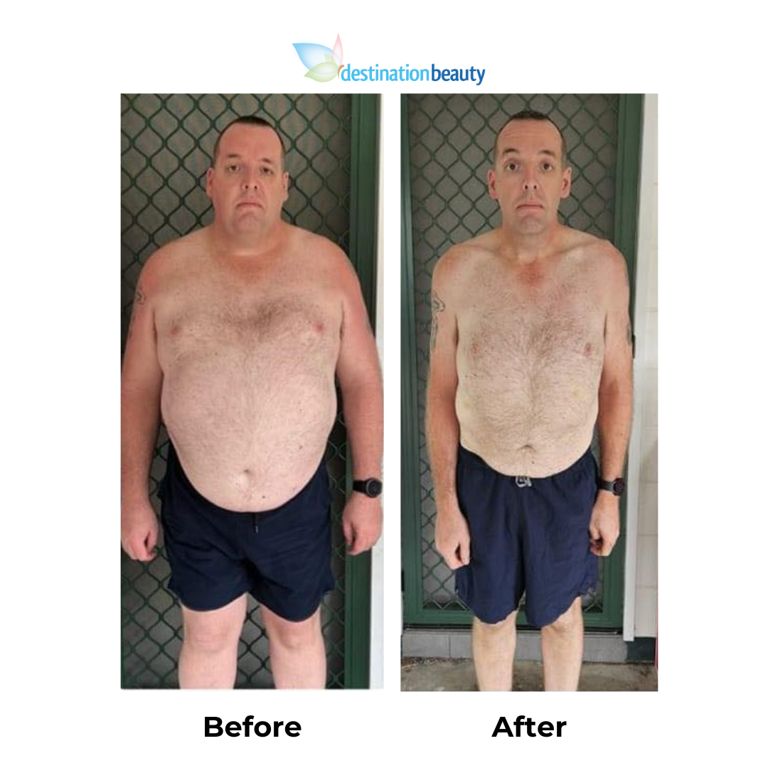 Ben had gastric sleeve (2)