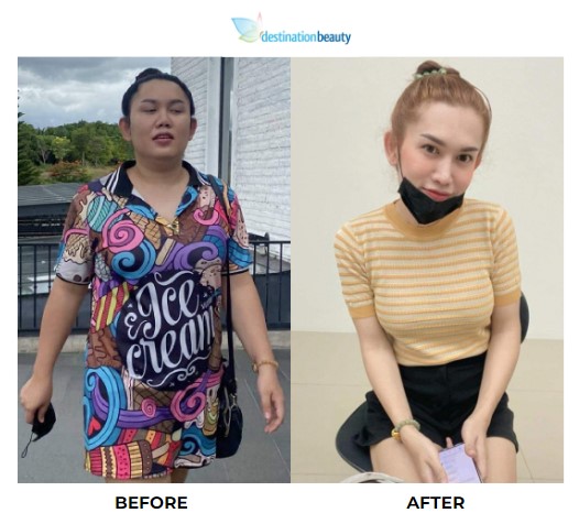 Best weight loss surgery