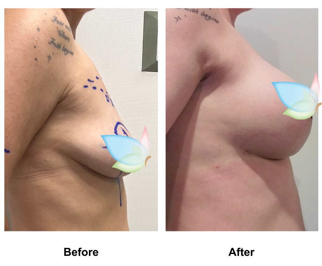 Bianca had BABL (300 cc) with Dr. Kasemsak (1)