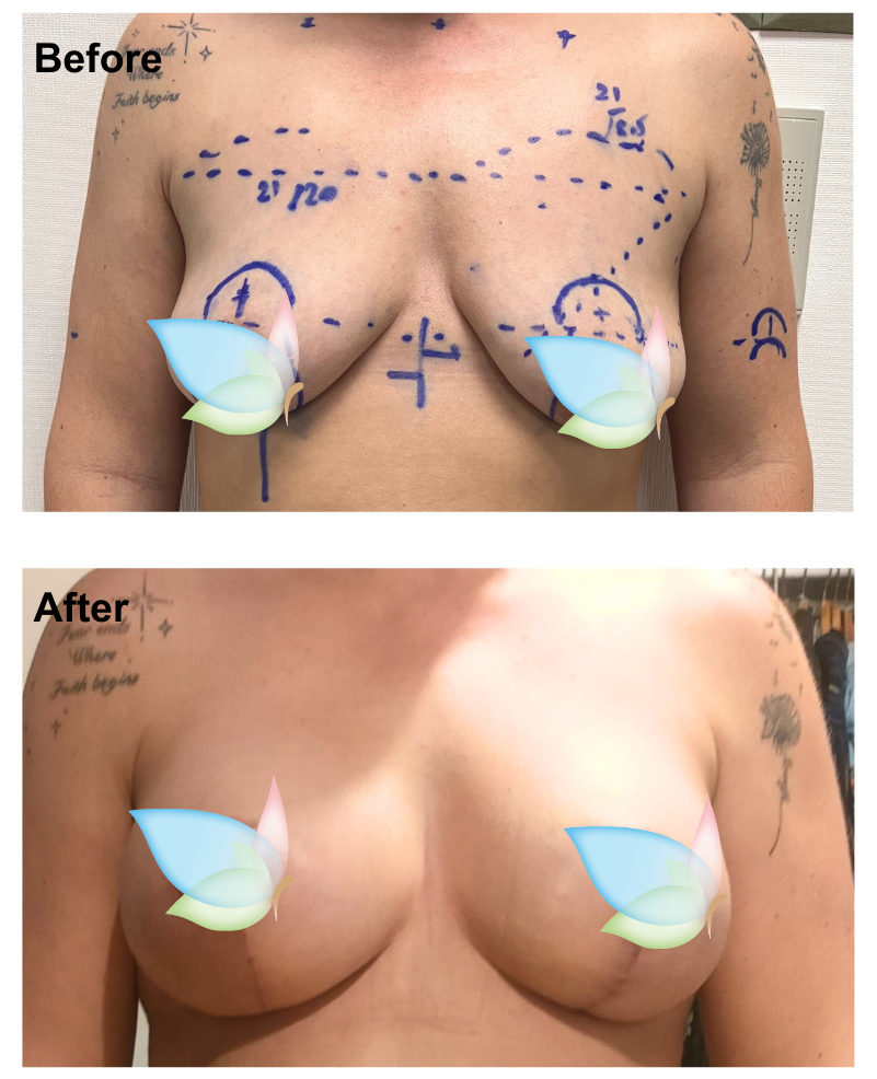 Bianca had BABL (300 cc) with Dr. Kasemsak