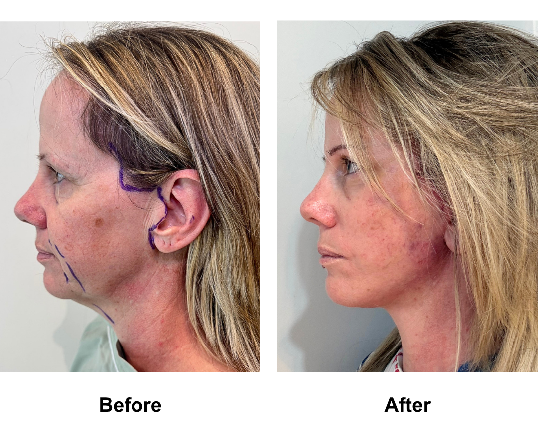 Bianca, 52 had FFNL with Dr. NJ (2)