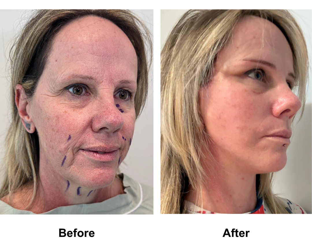 Bianca, 52 had FFNL with Dr. NJ (3)