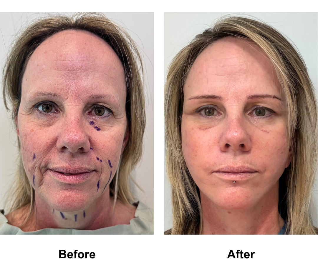 Bianca, 52 had FFNL with Dr. NJ