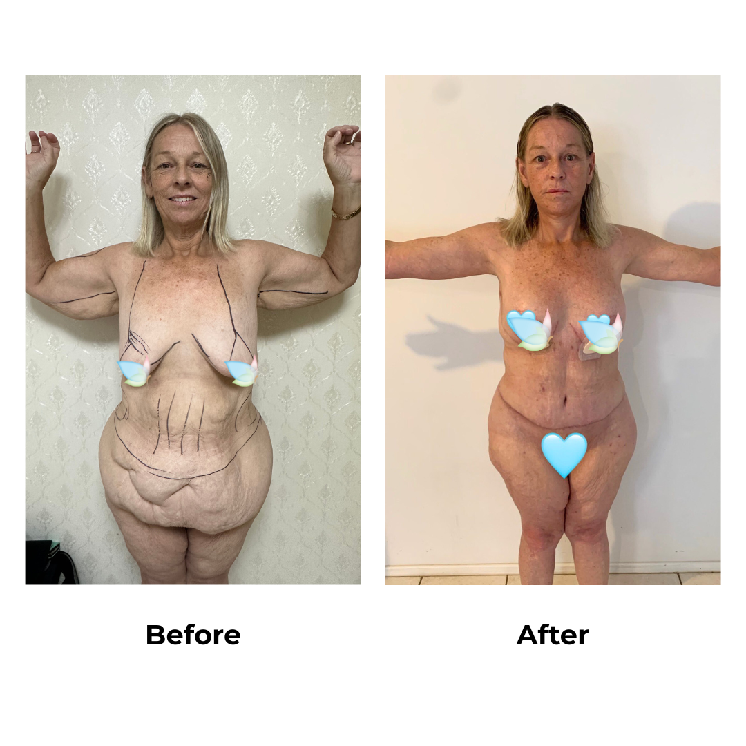 Braline Lift + ExTT + Lipo2 + ML + AL + lipo arm + BABL (300 HP) + SL 