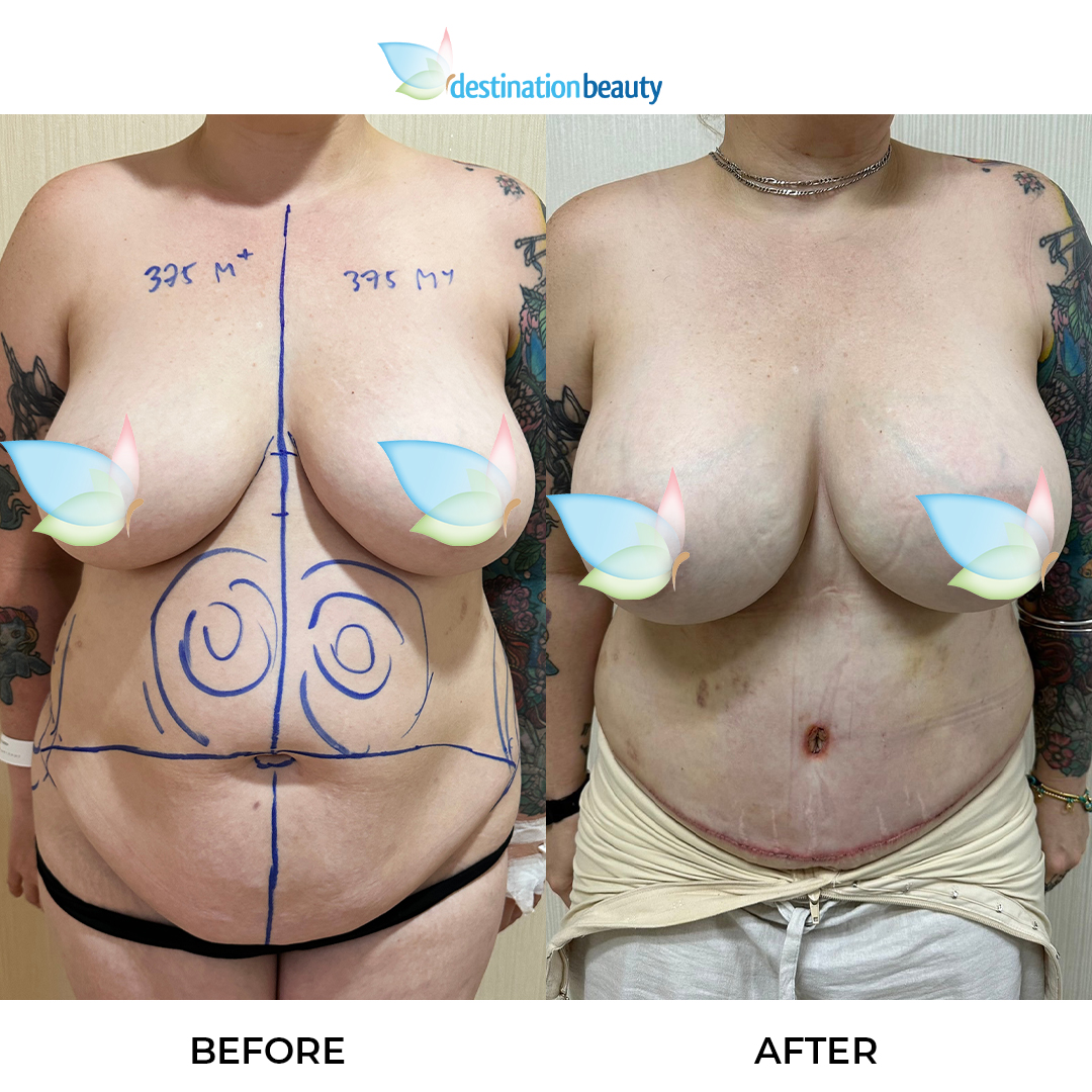 Breast Augmentation, Extended Tummy Tuck, and Liposuction (2)